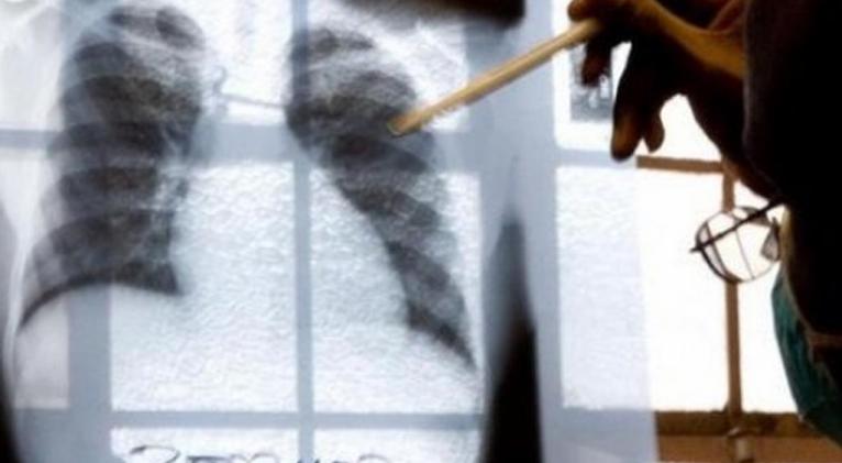 tuberculosis 